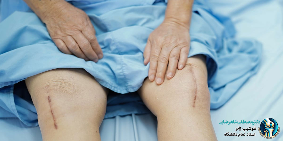 جراحی زانو یا فیزیوتراپی