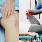 جراحی زانو یا فیزیوتراپی