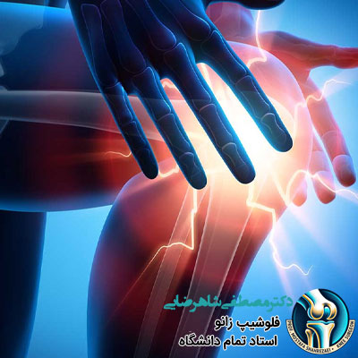آرتروز زانو در جوانان؛ چرا و چگونه