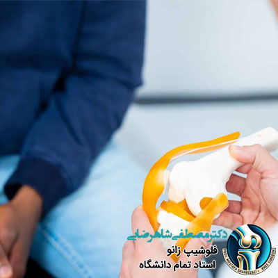  لوز بادی یا اجسام شناور در مفصل زانو