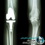 جراحی مجدد تعویض مفصل زانو