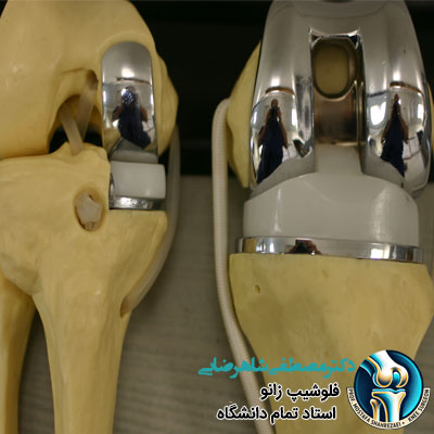 آیا با آرتروز زانو می‌توان پیاده‌ روی کرد