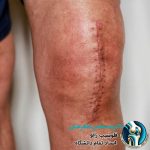 علت خشکی زانو بعد از عمل تعویض زانو
