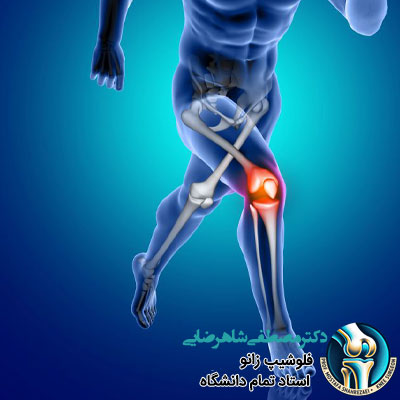 دررفتگی مکرر کشکک زانو