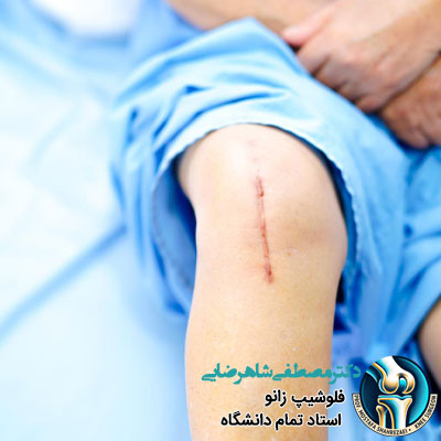 مصرف آنتی‌ بیوتیک بعد از جراحی زانو