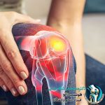 چه زمانی وقت تعویض مفصل زانو است